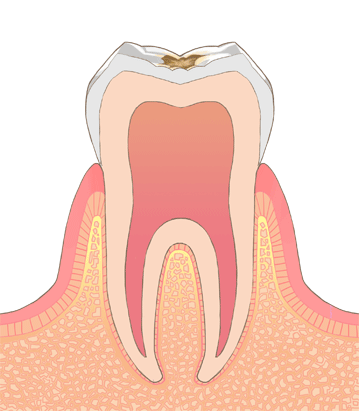 虫歯の中期（C1-C2）
