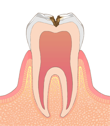 虫歯の後期（C3）