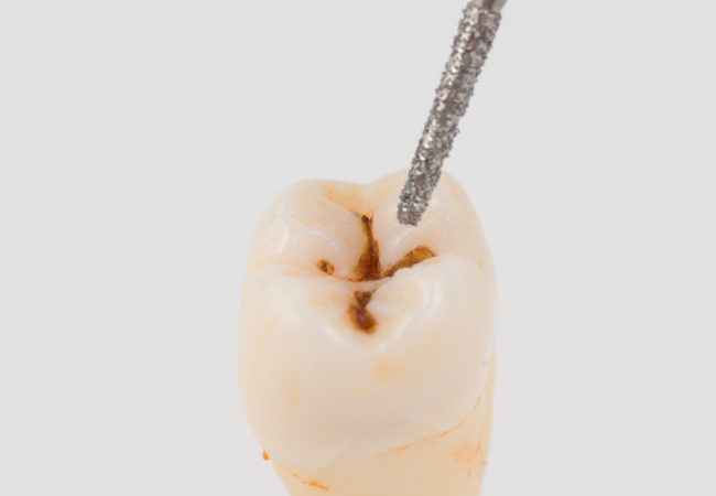 虫歯の初期（C0）
