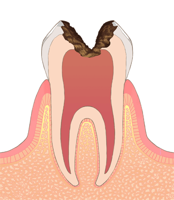 虫歯の末期（C4）